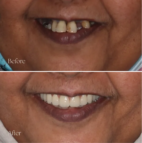 Results From Dental Implants Treatment