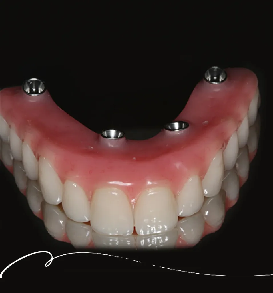 Dental Implants in Moonee Ponds