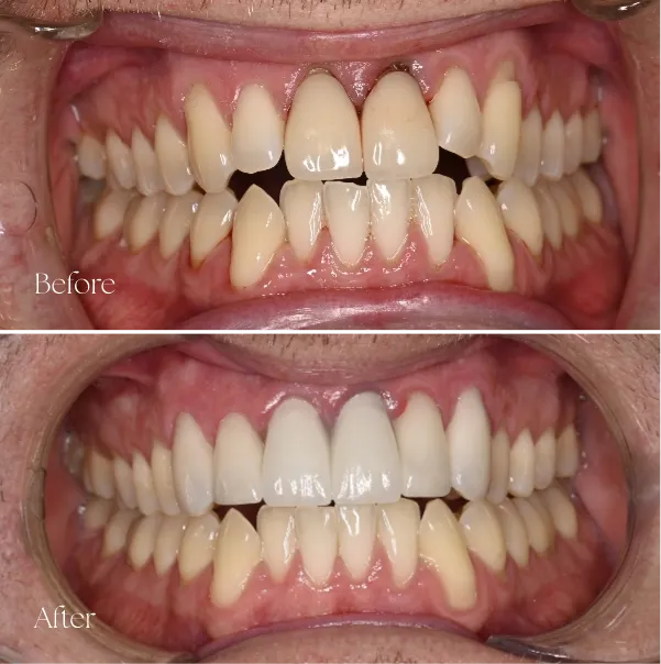 Crowns & Bridges Results