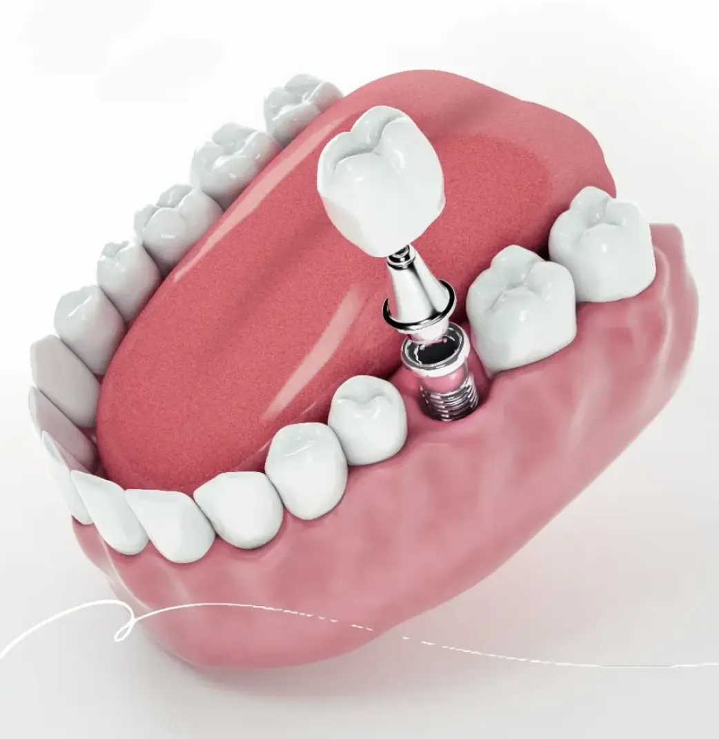 Dental Implants