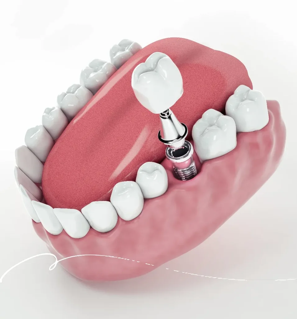 Dental Implants in Moonee Ponds