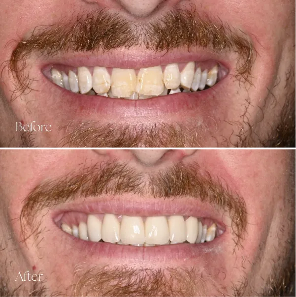 Before and after veneers