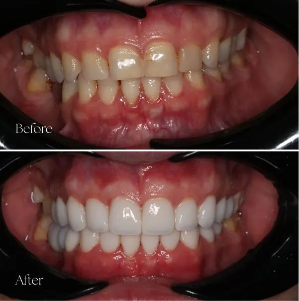 Before and after result of veneers