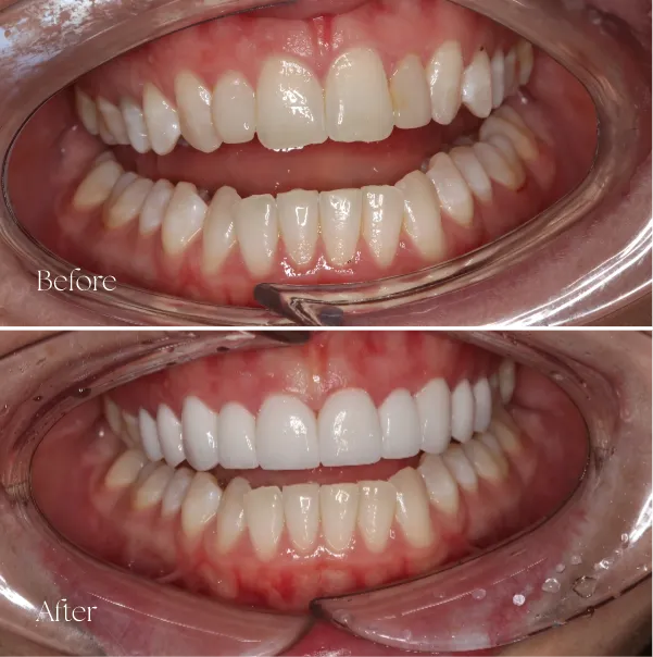 Result From Veneers Treatment