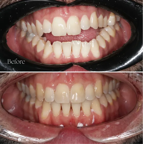 Clear Aligners Ascot Vale