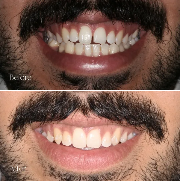 Ascot Vale Clear Aligners
