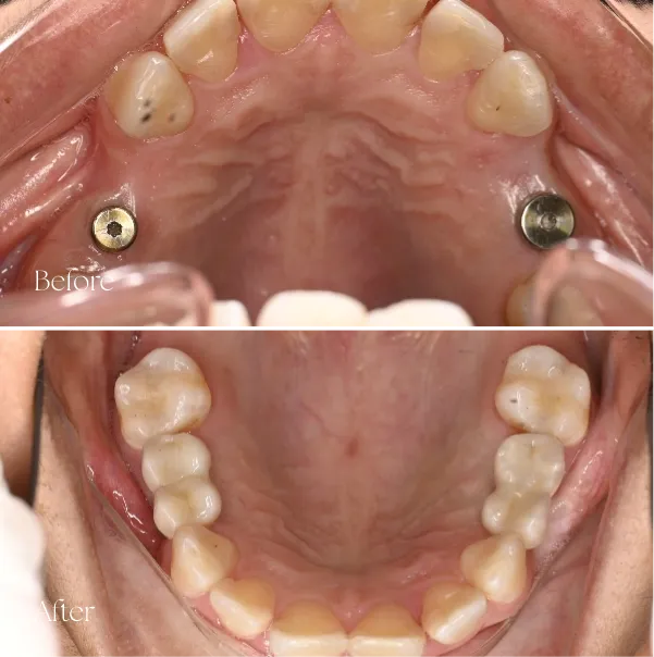 Affordable Dental Implants Footscray