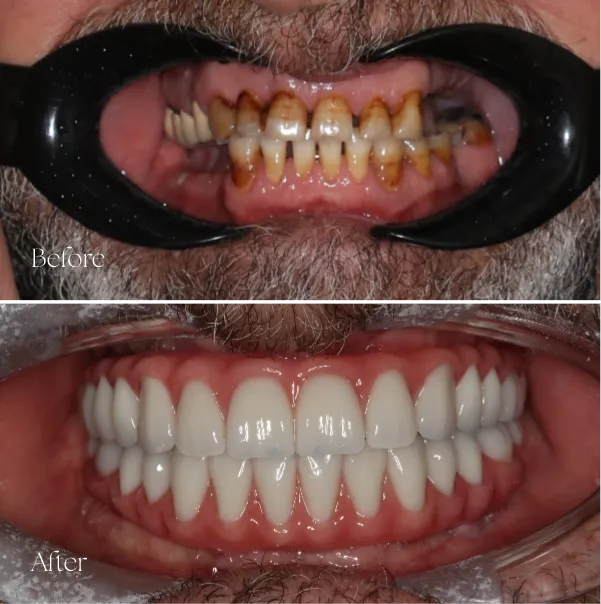 Dental Implants Treatment