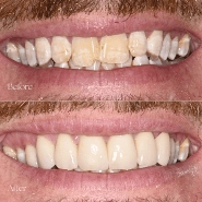 Dental Transformation 4 Flemington