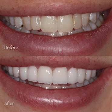 Dental Transformation 6 Flemington
